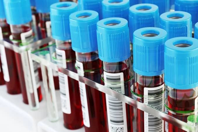 Exame de sangue mostra melhor tratamento para câncer de próstata