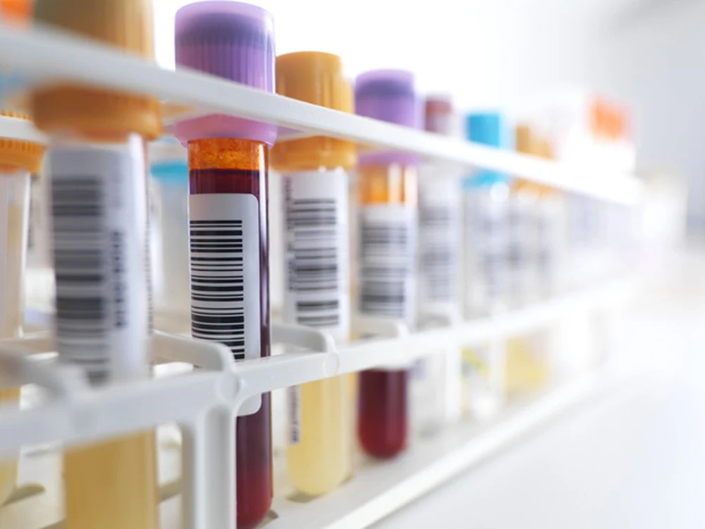 Exame de sangue detecta ressurgimento de câncer com 1 ano de antecedência